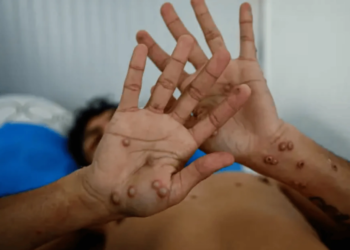 Quintana Roo en el segundo lugar por casos de viruela símica