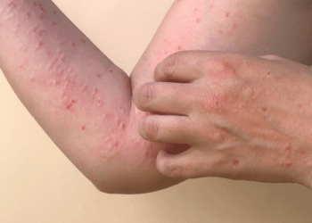 Refuerzan acciones preventivas contra la viruela del mono en Quintana Roo