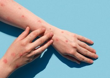 Tabasco sin riesgo Inmediato por Mpox detectada en Campeche