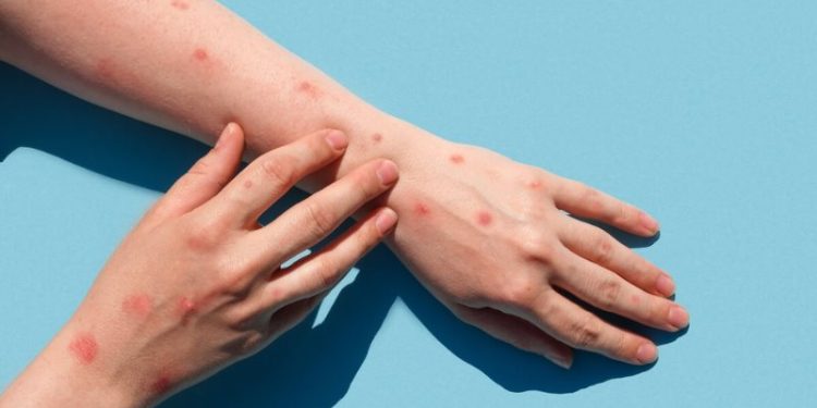 Tabasco sin riesgo Inmediato por Mpox detectada en Campeche