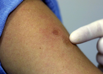 Registran 114 casos de viruela símica en el país