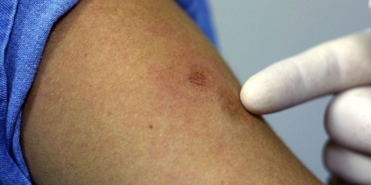 Registran 114 casos de viruela símica en el país