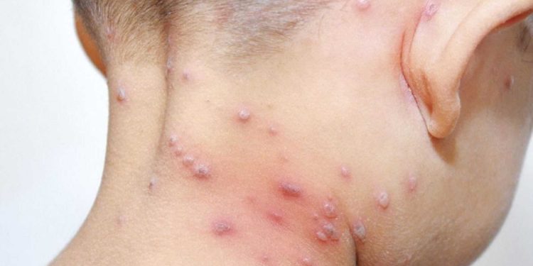 Se disparan los casos de varicela en Tabasco: van 919 en lo que va del año