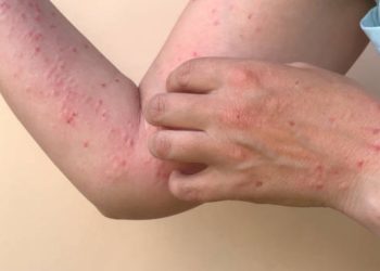 Chihuahua supera los 2,000 casos de sarampión