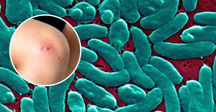 Alertan por bacteria “come carne” tras ocho muertes en EE.UU.