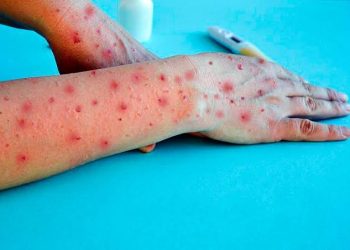 Viruela del Mono en Quintana Roo