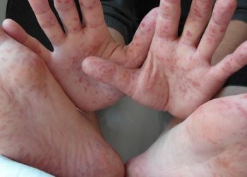 Un brote del virus coxsackie se registró en Campeche