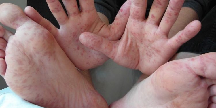 Un brote del virus coxsackie se registró en Campeche