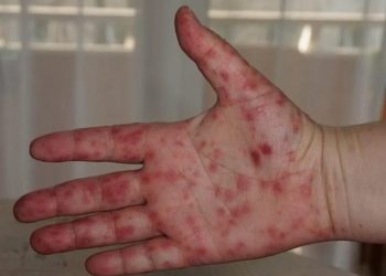Alerta sanitaria en Tankuché por brote de virus Coxsackie