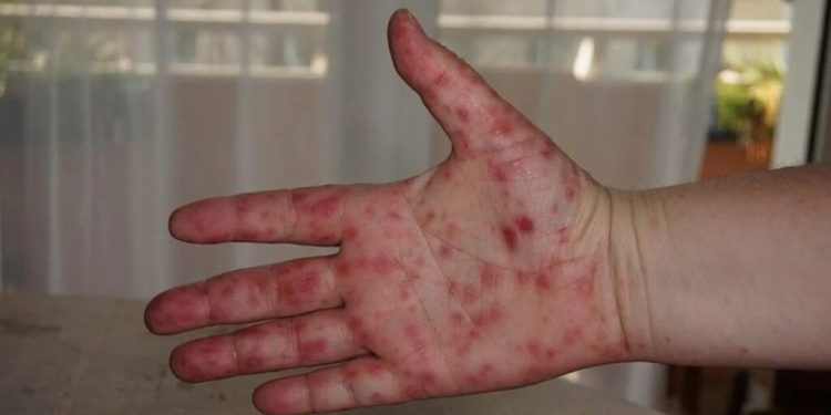 Alerta sanitaria en Tankuché por brote de virus Coxsackie