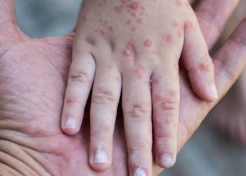 Confirman presencia de virus Coxsackie en Playa del Carmen