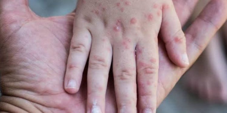 Confirman presencia de virus Coxsackie en Playa del Carmen