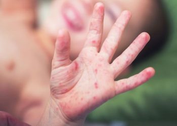 Oaxaca reporta aumento de casos de virus Coxsackie entre niños