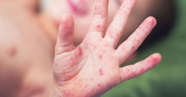 Oaxaca reporta aumento de casos de virus Coxsackie entre niños