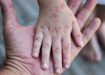 Refuerzan medidas sanitarias en escuelas de Quintana Roo ante casos de virus Coxsackie
