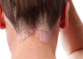 Día Mundial de la Psoriasis: Un Llamado a la Conciencia y el Apoyo