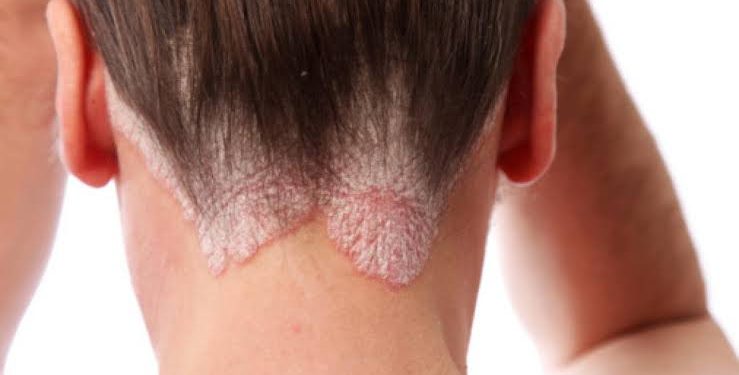 Día Mundial de la Psoriasis: Un Llamado a la Conciencia y el Apoyo