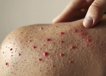 Estado de México reporta 12 contagios confirmados de sarampión