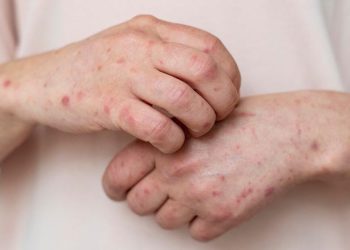 Salud refuerza vacunación en Tabasco para contener contagios de sarampión