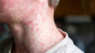 Tabasco registra 12 casos de sarampión; autoridades refuerzan llamado a vacunación