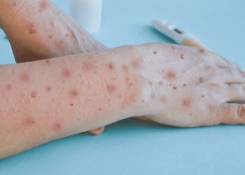 Confirman en México el primer caso de viruela símica subclado Ib en ciudadano alemán