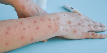 Confirman en México el primer caso de viruela símica subclado Ib en ciudadano alemán