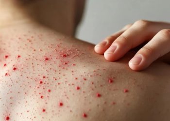 Alerta sanitaria: repunte de sarampión se extiende en todo el país; autoridades llaman a vacunarse