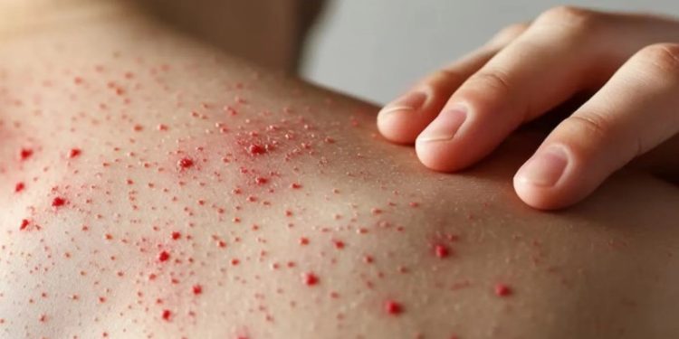 Alerta sanitaria: repunte de sarampión se extiende en todo el país; autoridades llaman a vacunarse