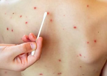 Tabasco acumula 19 casos de sarampión y asciende al lugar 16 a nivel nacional