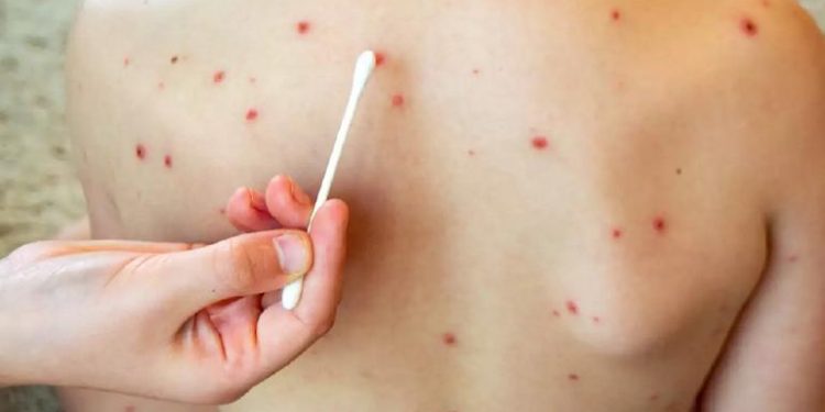 Tabasco acumula 19 casos de sarampión y asciende al lugar 16 a nivel nacional