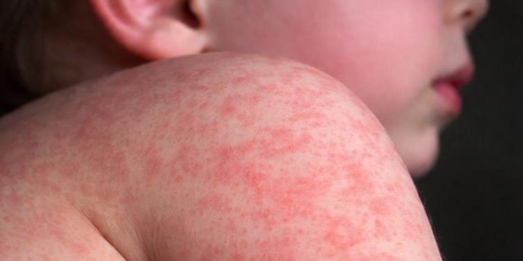 Muere menor por complicaciones de sarampión en Tlaxcala; no tenía esquema completo de vacunación