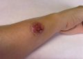 Quintana Roo encabeza casos de leishmaniasis a nivel nacional con 312 contagios confirmados