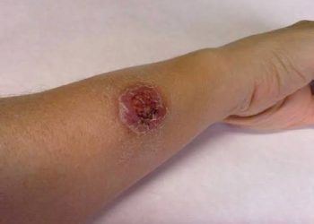 Quintana Roo encabeza casos de leishmaniasis a nivel nacional con 312 contagios confirmados